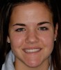 Figure 4 The dental midline is in improved harmony with the facial midline following the second round of orthodontic treatment.