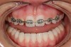 Figure 3 Additional orthodontic treatment is initiated to improve the dental midline and evenly distribute the space around the microdontic lateral incisors.