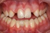 Figure 6 The orthodontic treatment created divergence of the coronal tooth structure and convergence of the roots around the edentulous spaces.