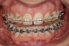 Figure 10 Orthodontics were utilized to more evenly distribute spaces and widen the arch form.