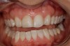 Figure 8 A lack of harmony in tooth size and position for an adult patient treated with cuspid substitution to replace the congenitally missing maxillary lateral incisors.