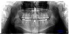 Figure 7 The panographic radiograph shows the roots of the cuspids encroaching upon the edentulous spaces. Additional orthodontic treatment will be required before implants can be placed to replace the missing teeth.
