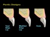 Figure 15 An ovate pontic supports the facial gingival margin and allows the prosthetic replacement to appear, as would a natural tooth, to emerge from the gingiva.