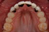 Figure 18 Limiting the metal framework of the adhesively retained bridges to the cingulum areas prevents metal show-through on the abutment teeth.