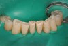 Figure 4  Prepared incisal edges to be restored