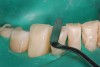 Figure 5  Placement of composite resin to restore incisal edges.