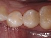 Figure 1  Preoperative view of a patient who presented with interproximal caries located between the mesial of the premolar and the distal of the premolar.