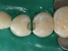 Figure 4  Decay removed and view of final cavity preparations.