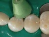 Figure 17  Jiffy green cup was used initially to polish the patient’s restorations.
