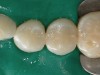 Figure 19  Immediate postoperative view of the completed restorations, after which the rubber dam was removed for verification of the occlusion.