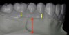 Figure 2  Side view of 0.020 vacuum formed material on the study model. The yellow arrows  show the remaining amount of material beyond the gingival margin. The red arrows show  the amount of uncovered area (vestibule) on the model.