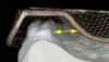 Figure 3  Yellow arrows show the space between a maxillary stock metal tray and the lingual side of the molar region.