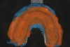 Figure 9  Final impression with uniform thickness of the light-bodied wash material.