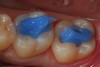 Figure 1  Before placement of the glass-ionomer cement base, the dentin is etched with 37% phosphoric acid for 2 seconds only.