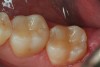 Figure 3  An occlusal view of the completed 