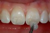 Figure 5  After air-drying the tooth surface, it is rewetted with a desensitizer to help seal the dentinal tubules with HEMA and fluoride before the application of the bonding agent.