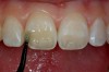 Figure 7  The prepared enamel and  dentin is saturated with bonding resin.