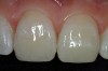 Figure 8  Completed direct composite restorations on tooth Nos. 8 and 9.