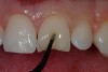 Figure 9  A self-etching dentin bonding agent was applied to the prepared tooth surface in a brushing (scrubbing) motion.