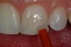 Figure 14  An incisal shade of composite is placed on the area to be restored.