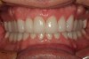 Figure 23  A 1-year follow-up of the completed maxillary and mandibular reconstruction cemented with self-etching resin cement. Occlusal stability and gingival health have been achieved and maintained.