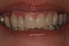 Figure 6  A 1-week postoperative view of direct bonded veneers on teeth Nos. 9 and 10.
