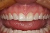 Figure 12  The 4-week postoperative photograph after the gingivectomy has been performed.