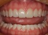 Figure 13  The 4-month postoperative view of the 10 no-preparation porcelain veneers.