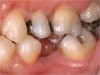 Figure 1  Long-standing missing tooth No. 19.