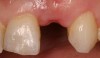 Figure 3a  Missing tooth No. 10, with associated vertical and horizontal boney deficiency. Failed implant treatment from a precious dental provider. Patient not interested in a second attempt with associated grafting and subsequent implant surgery.