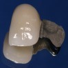 Figure 3b  Patient elected to proceed with a conservative 2-unit resin-bonded FPD, with the wing retainer bonded to the lingual surface of tooth No. 11.