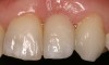 Figure 3c  Patient elected to proceed with a conservative 2-unit resin-bonded FPD, with the wing retainer bonded to the lingual surface of tooth No. 11.