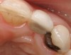Figure 3d  Patient elected to proceed with a conservative 2-unit resin-bonded FPD, with the wing retainer bonded to the lingual surface of tooth No. 11..