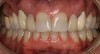 Figure 4a  Before treatment, missing lateral incisors replaced with failing conventional cantilever FPDs with canine abutments. Patient lacked inter-root space for implant therapy, denied orthodontic therapy, and chose revision FPD therapy.