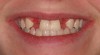 Figure 5b  Congenitally missing lateral incisors. Postorthodontic therapy, prior to implant placement.