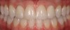 Figure 5d  Completed, porcelain-fused-to-gold implant restorations, custom gold abutments, lingual-set screw-retention, Kerr Extrude¬Æ light-body crown-abutment seal.
