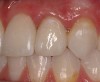 Figure 5f  Completed, porcelain-fused-to-gold implant restorations, custom gold abutments, lingual-set screw-retention, Kerr Extrude¬Æ light-body crown-abutment seal.