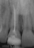 Figure 6c  Upper right central incisor, history of trauma, existing RCT and restoration unsatisfactory.