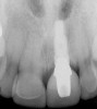 Figure 7e  Completed single all-ceramic screw-retained implant crown site on tooth No. 9, revised porcelain three-quarter laminate veneers for teeth Nos. 8 and 9, cemented with Kerr NX3 Nexus¬Æ Third Generation Dual Cure Resin cement.