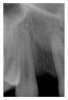 Figure 2  Pretreatment digital radiograph, right lateral incisor.