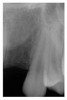 Figure 3  Pretreatment digital radiograph, left lateral incisor.