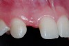 Figure 4  Pretreatment clinical view, right lateral incisor.
