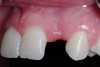 Figure 5  Pretreatment clinical view, left lateral incisor.
