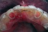 Figure 7  Intraoral occlusal view, TempStent II Surgical Guide.