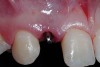 Figure 9  Minimally invasive small-diameter implant placement.
