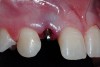 Figure 11  Minimally invasive bone grafting at the facial of No. 7.