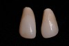 Figure 13  Esthetic immediate provisionals.