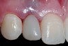 Figure 14  Immediate postoperative view; right lateral incisor.
