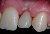 Figure 15  Immediate postoperative view; left lateral incisor.