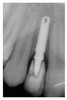 Figure 16  Immediate postoperative digital periapical; right lateral incisor.